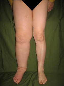 下肢リンパ浮腫　軽症例<br />
子宮癌術後（右脚）