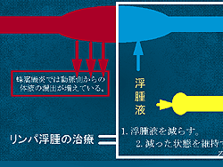 蜂窩織炎の治療 むくみのページ リンパ浮腫の原因 専門医 治療ならむくみ情報サイト